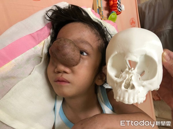 ▲鼻額部「腦膨出」 2歲童「高爾夫球肉瘤」擠成金魚眼。(圖/台北榮總提供)