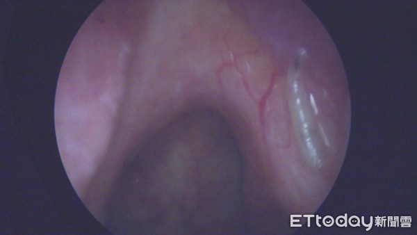 ▲▼85歲老翁鼻孔長蛆。(圖/陳榮峰醫師提供)