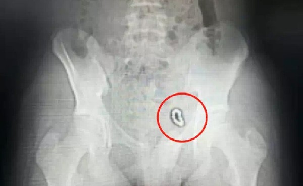 13歲童下體塞14顆巴克球　跑步超痛膀胱照出「磁力串」。（圖／翻攝自大陸《南方都市報》）