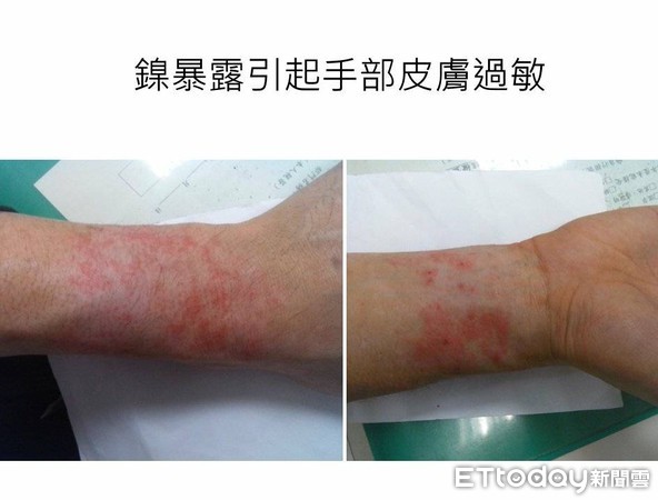 ▲天天皮膚癢、流鼻血 他工作4年被這「重金屬」害慘了。(圖/長庚醫院提供)