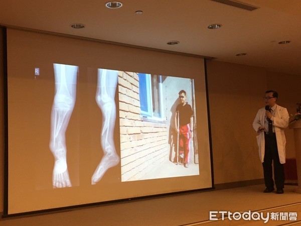 ▲骨折9年「長短腳15公分」 三總幫蒙古男孩找到真正原因 。(圖/記者嚴云岑攝)