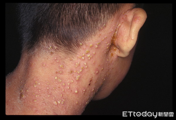 異位性皮膚炎「癢到凍未條」 他40年來每天只熟睡1小時。(圖/公關提供)