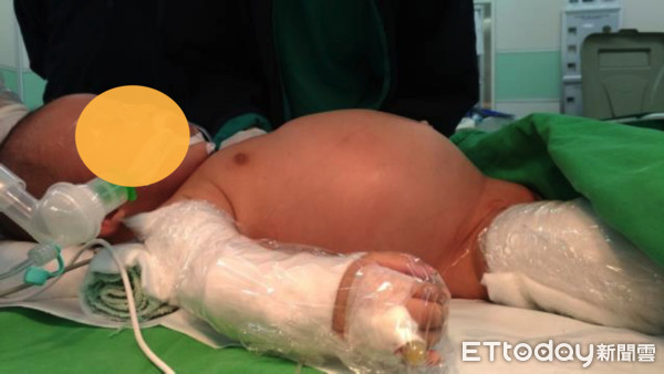 ▲罕見嬰幼兒胃部畸胎瘤。(圖/三總提供)