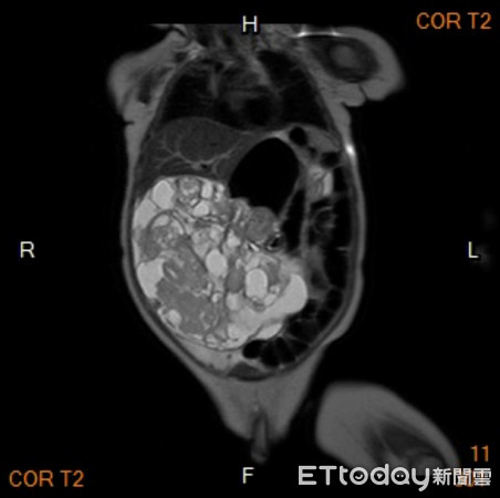 ▲畸胎瘤。(圖/三總提供)