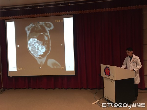 敲小孩肚子發出「碰碰」聲!家長當心 恐藏巨型「畸胎瘤」。(圖/記者嚴云岑攝)