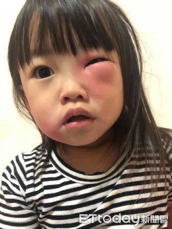 ▲1個月被蚊子虐3次！2歲妹萌眼爆腫。（圖／洪湘茵授權引用）