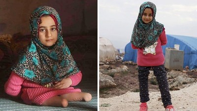 「站著行走」是她的夢想！難民女童靠鐵罐爬行　如今獲贈義肢展笑顏