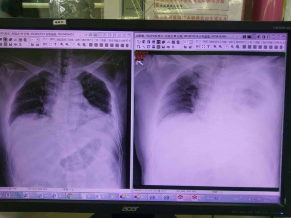 ▲▼范可欽的肺部X光片。左邊這張是剛發生時在急診室拍的。右邊這張是今天拍的。整個左邊的肺都看不到一片白茫茫，嚴重出血。（圖／粘嫦鈺提供）