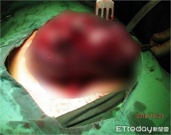 ▲▼小港醫院婦產科劉奕吟子宮肌瘤。(圖/小港醫院提供)