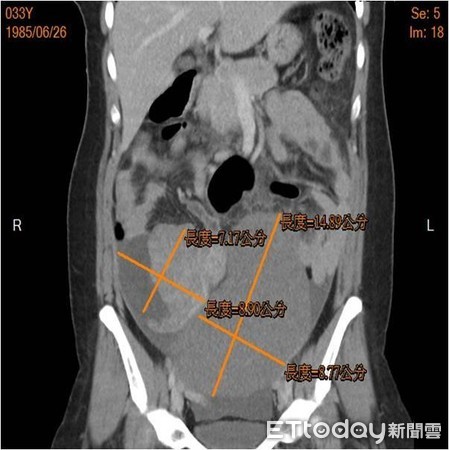 ▲▼小港醫院婦產科劉奕吟子宮肌瘤。(圖/小港醫院提供)