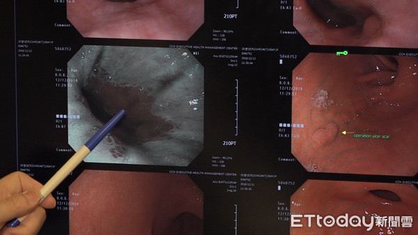 ▲食道癌,癌症,窄頻內視鏡,光學染色,醫療,檢查,健康檢查,醫療檢查,檢查室,檢驗器材,醫療器材。（圖／記者謝婷婷攝）