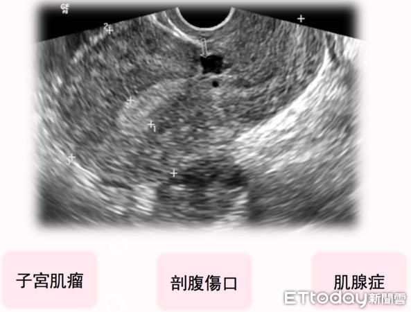 ▲她二胎做7年都失敗! 竟是剖腹產在子宮留下「怪東西」。(圖/記者嚴云岑攝)