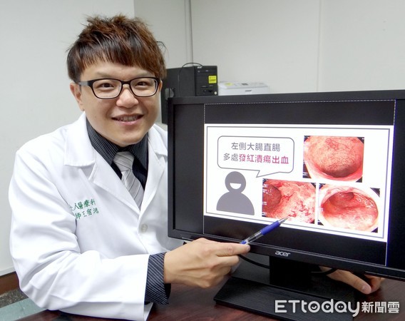 ▲▼慢性腸道發炎。(圖/奇美醫學中心提供)