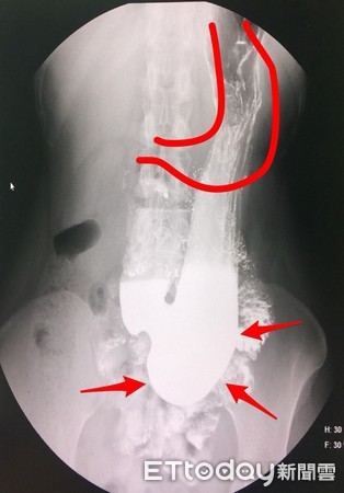 ▲▼胃下垂。(圖/錢政弘醫師提供)