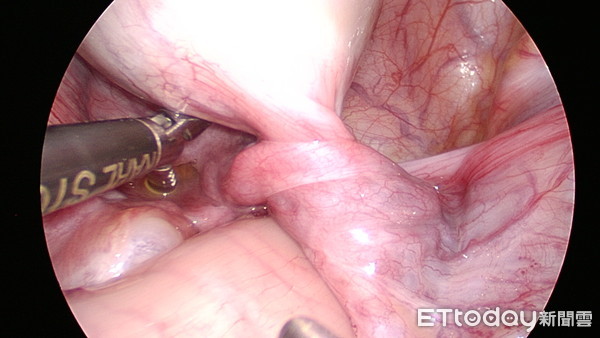 ▲▼部硬塊是「畸胎瘤扭轉」 急開刀保住卵巢。(圖/亞大醫院提供)