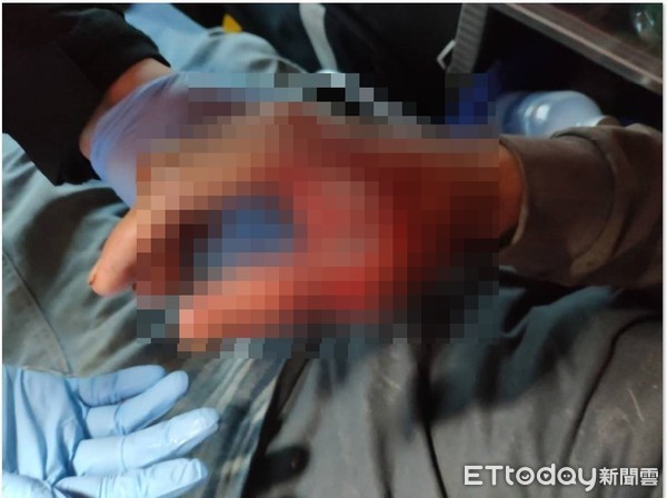 ▲▼鞭炮炸傷手。(圖/記者楊均典攝)