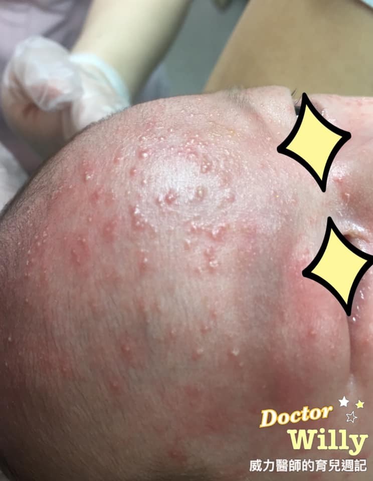 ▲▼兒童皮膚。(圖/王韋力醫師提供)