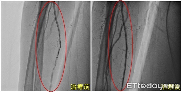 ▲▼亞大醫院心臟檢查室主任張育晟替病人擦藥。(圖/亞大醫院提供)