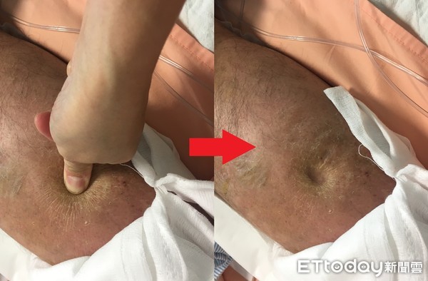 ▲▼下肢水腫,下肢靜脈血栓。(圖/亞洲大學附屬醫院提供)