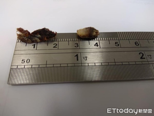 ▲▼耳屎。(圖/門諾醫院提供)