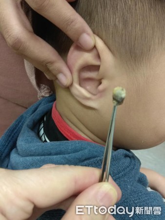▲▼耳屎。(圖/門諾醫院提供)