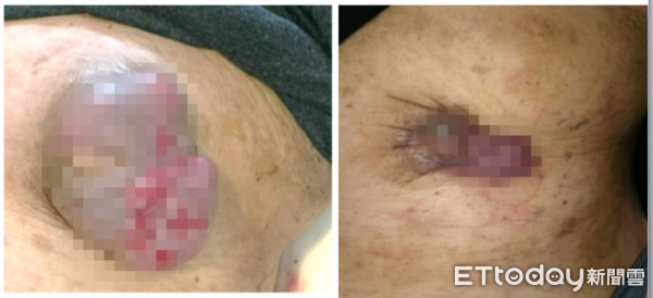 ▲男性也會得乳癌。(圖/中國附醫提供)