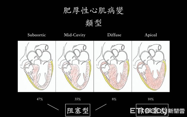 ▲跑步易喘、胸悶別輕忽!「肥厚性心肌病變」一有症狀就猝死。(圖/記者嚴云岑攝)