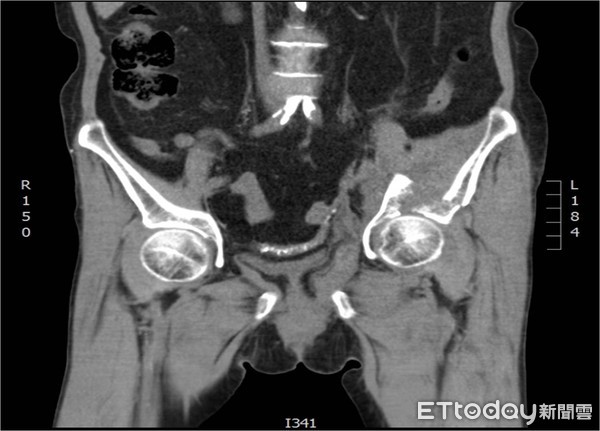 ▲▼ 圖說:陳柏辰醫師。電腦斷層顯示嚴重髖臼骨折(圖右)。(圖/彰化醫院提供)