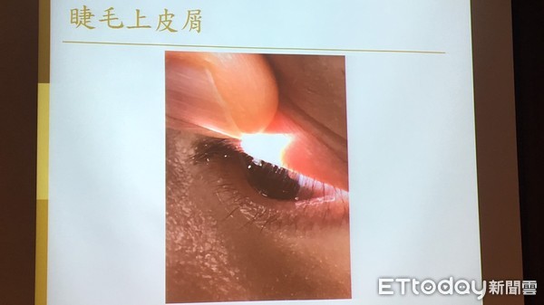 ▲掀開蟎蟲狂蠕動!她針眼半年好不了 問題竟在「假睫毛」。(圖/記者嚴云岑攝)