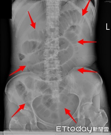 ▲▼大不出來!她天天吃地瓜、紫米...腸道竟塞「20顆石頭糞」。(圖/錢政弘醫師提供)