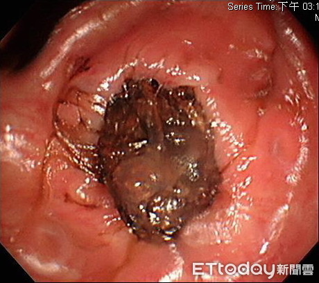 ▲▼大不出來!她天天吃地瓜、紫米...腸道竟塞「20顆石頭糞」。(圖/錢政弘醫師提供)