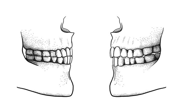 ▲古代的咬合（左）與現代的咬合（右）之間的區別。（圖／翻攝自TímeaBodogán）