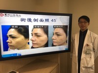 鼻形內塌陷還產生阻塞，呼吸通暢度受影響，每次呼吸都像有人用手掐住鼻子，嚴重外觀畸形讓她整天以淚洗面，每天都要戴口罩才敢出門。