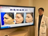 開刀次日即可出院，6個月後鼻子外觀也與常人無異，「病患還說，鼻背比發炎前還好看。」