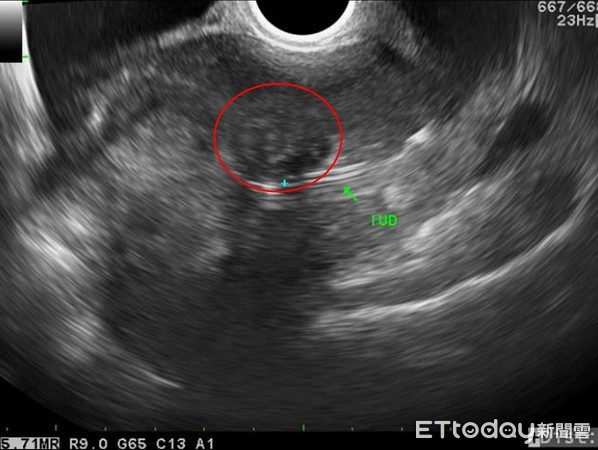 ▲手術前檢查出的子宮肌瘤。(圖/花蓮慈院提供)