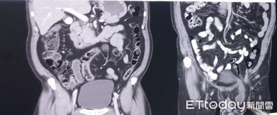 ▲▼。(圖/豐原醫院提供)