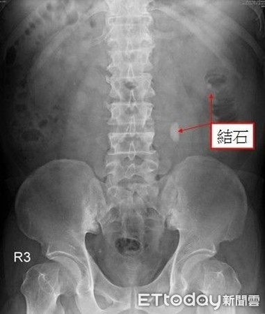 ▲▼。(圖/安南醫院提供)