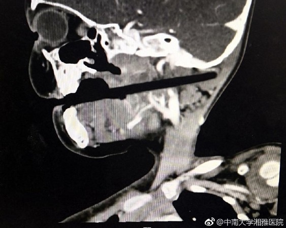 ▲▼邊吃飯邊玩耍　3歲女童跌倒筷子插顱10公分。（圖／翻攝自中南大學湘雅醫院微博）