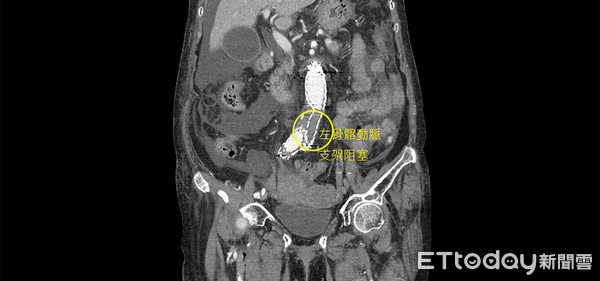 ▲▼圖一:左骨髂動脈支架嚴重阻塞。圖二:右骨髂動脈支架末端有8公分大的血管瘤。。(圖/澄清醫院提供)