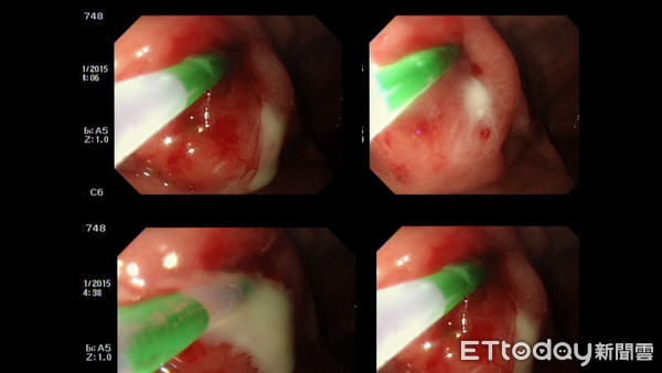 ▲▼赤腳水池邊散步要小心 脾、胃膿瘍竟是「類鼻疽感染」 。(圖/義大醫院提供)