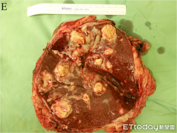 ▲▼赤腳水池邊散步要小心 脾、胃膿瘍竟是「類鼻疽感染」 。(圖/義大醫院提供)