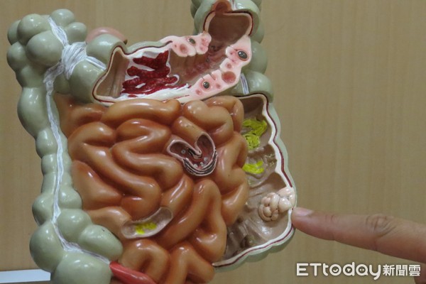 ▲▼腸息肉。(圖/台中慈濟醫院提供)