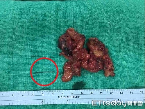 ▲▼。(圖/高醫附設醫院提供)