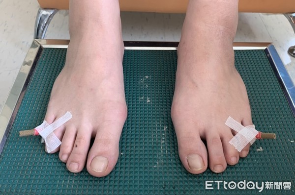 ▲▼艾灸,胎位不正,懷孕,中醫。(圖/高雄醫學大學附設醫院提供)