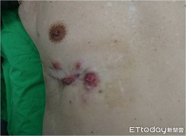 ▲▼蟹足腫 。(圖/郭耀仁醫師提供)