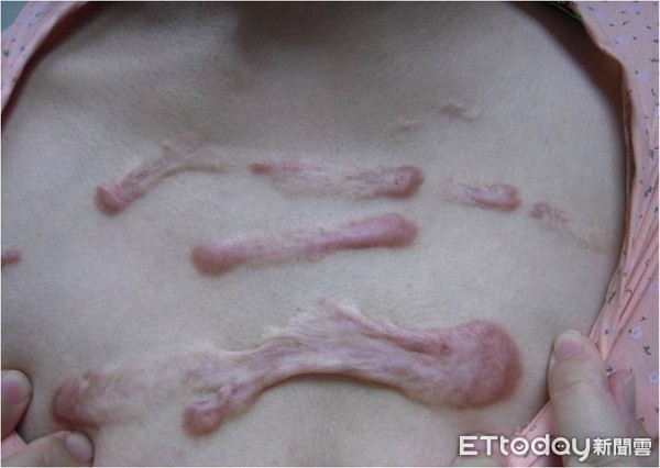 ▲▼蟹足腫 。(圖/郭耀仁醫師提供)