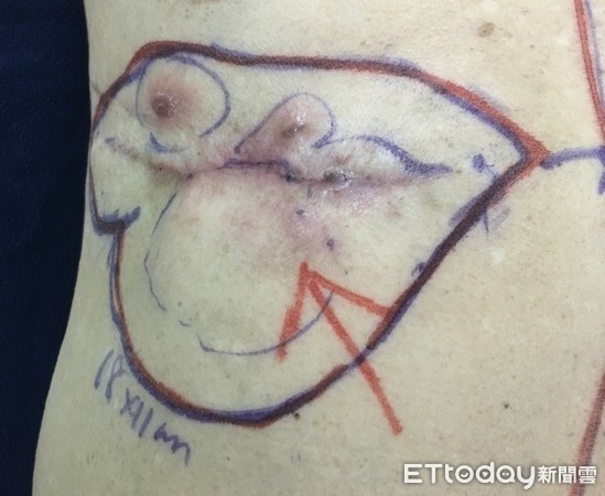 ▲▼蟹足腫。(圖/郭耀仁醫師提供)