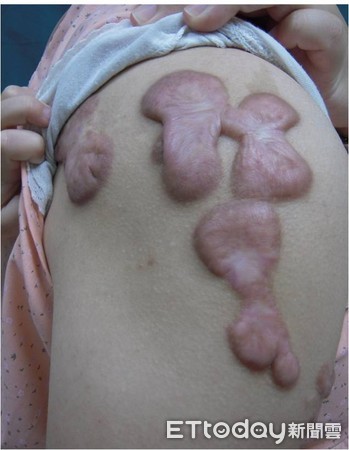 ▲▼蟹足腫。(圖/郭耀仁醫師提供)