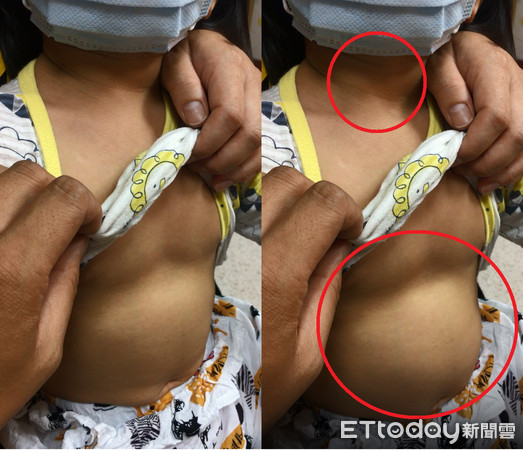 ▲▼兒童呼吸困難。(圖/王韋力醫師提供)