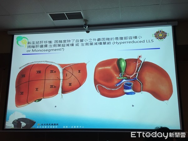媽坐月子切肝救罕病兒! 北榮幫25天娃換肝「再創全台紀錄」。(圖/記者嚴云岑攝)